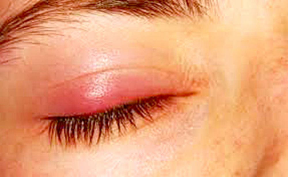 La limpieza adecuada de los párpados para evitar la blefaritis