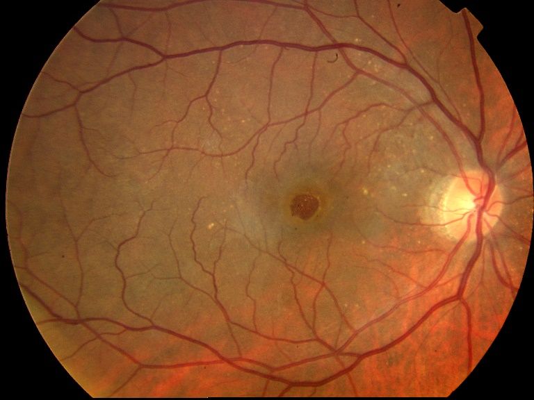 ¿Qué es el agujero macular y cómo se trata? | Dra. Alicia Domínguez de Bareiro