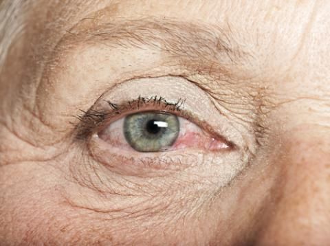 “Síndrome del ojo seco” | Dra. Alicia Domínguez de Bareiro